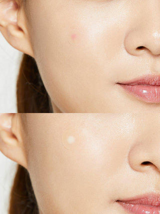 COSRX Acne Pimple Master Patch – 24 Patches - Kbeauty Canada