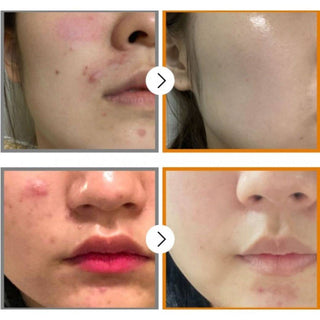 Numbuzin No.5 Goodbye Blemish Serum - Kbeauty Canada