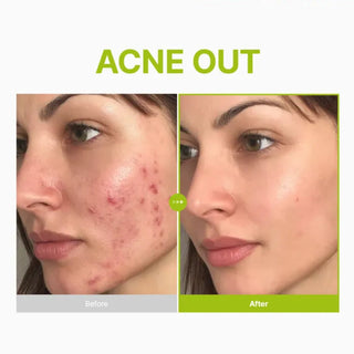 Purito Seoul Azelaic Acid 10 Kojic Tea Tree Serum 30ml bottle with dropper showing white serum inside.